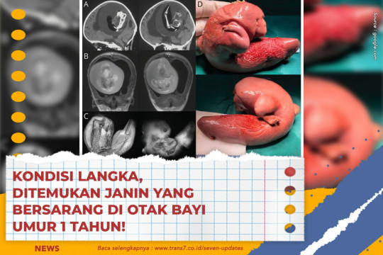 Kondisi Langka, Ditemukan Janin Yang Bersarang Di Otak Bayi Umur 1 Tahun!