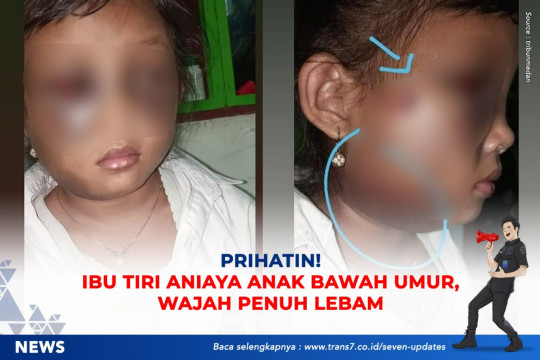 Prihatin! Ibu Tiri Aniaya Anak Bawah Umur, Wajah Penuh Lebam