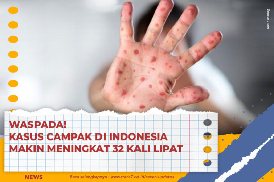Waspada! Kasus Campak Di Indonesia Makin Meningkat 32 Kali Lipat